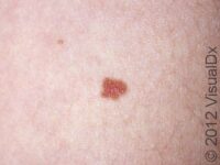 Mole (Nevus) – Adult