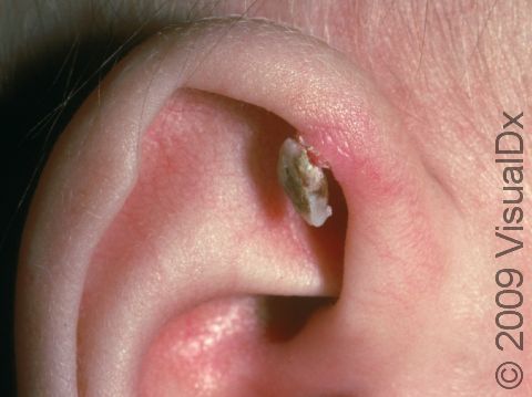 Warts can have a thick scale, which sometime become loose, as in this infant.