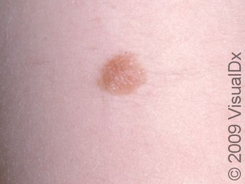 This image displays a close-up of a small congenital melanocytic nevus.