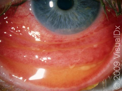 Conjunctivitis makes the surface of the eye red, and it can also make the inner lining of the eyelid red, accompanied by discharge.