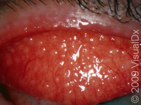 Surface changes with redness of the inner lining of the upper eyelid (tarsal conjunctiva) may occur in certain types of conjunctivitis.