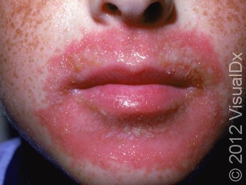 This image displays a severe contact allergy around the mouth.