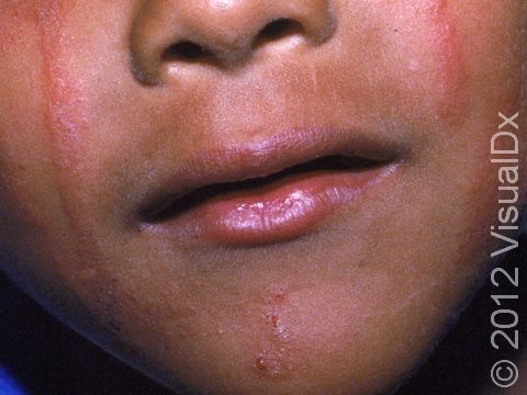 This image displays the linear areas of redness and scaling typical to a contact allergy.