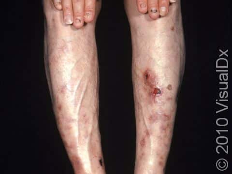 This image displays slow-healing skin lesions and ulcers due to simple trauma typical of diabetic dermopathy.