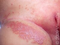 Diaper Dermatitis (Candidiasis) – Infant