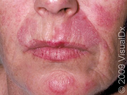 The dull red, scaling patches of discoid lupus are often circular or disc-shaped.