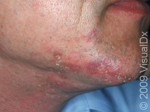 In discoid lupus erythematous, the skin can appear scarred with redness and scaling, as displayed in this image.