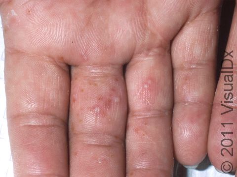 As displayed in this image, the blisters of dyshidrotic dermatitis are often difficult to see due to the thick skin of the palm and fingers.