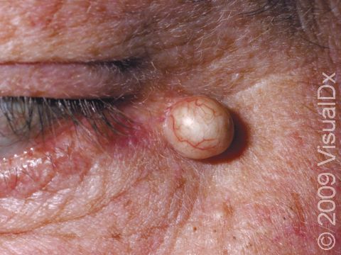 Epidermoid cysts are lined by skin cells that form a scale that accumulates in the cyst and appears as a creamy substance.