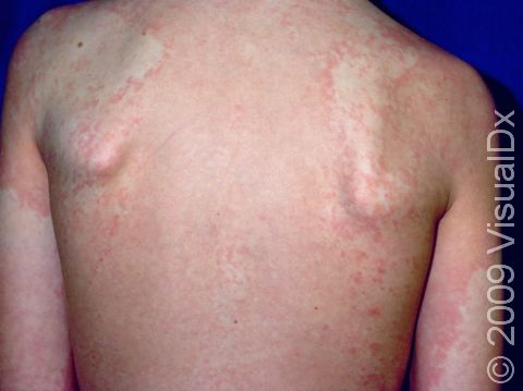 This image displays the widespread red bumps and slightly elevated lesions seen in erythema infectiosum (fifth disease).