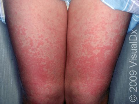 This image displays the extensive rash typical of fifth disease (erythema infectiosum).