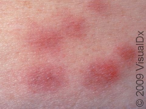 Erythema nodosum lesions are raised and tender when they begin (early lesions can be seen on the top part of this picture), but older lesions (seen on bottom part of the picture) flatten as they resolve.