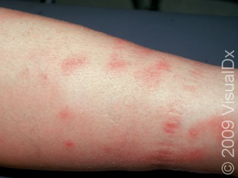 This image displays multiple areas of erythema nodosum.