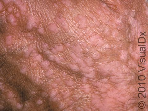 Flat warts are common on the face, arms, and legs and can be spread by scratching and shaving.