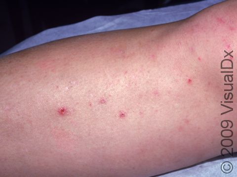 After the initial small, red bump or pus-filled lesion, folliculitis lesions often form a small crust or scab.