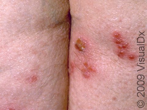 This image displays a grouping of blisters on the buttocks in a patient with herpes simplex.