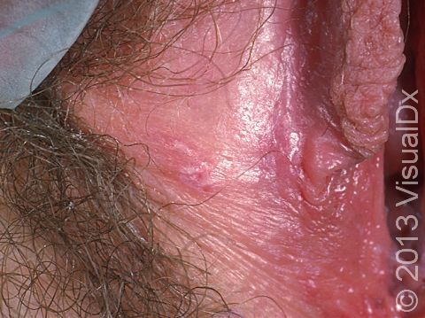 This image displays small blisters of a herpes infection (toward the bottom of the picture).