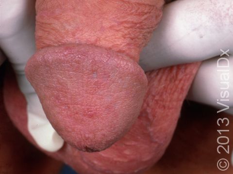 This image displays the eroded blisters of a herpes infection.