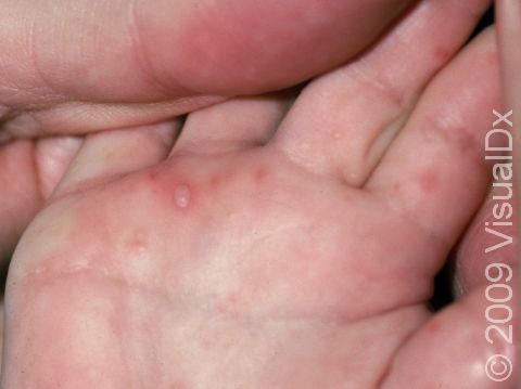 This image displays grouped blisters on the palm and fingers typical of a herpes virus infection.