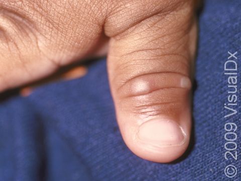 This image displays small blisters on the thumb of an infant with hand-foot-and-mouth disease.