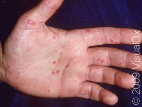 This image displays small blisters on the palm and fingers typical of hand-foot-and-mouth disease.