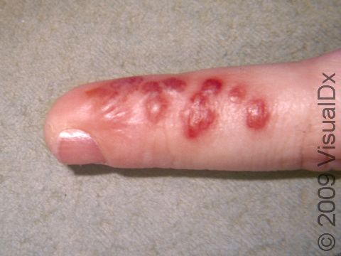 The blisters of a herpetic whitlow infection can be blood tinged.