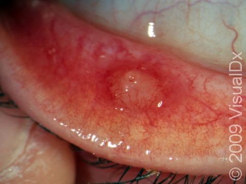 A chalazion/stye can occur on the inner surface of the eyelid (tarsal side).