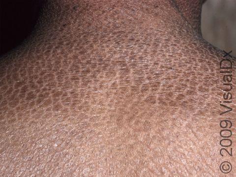 This image displays Ichthyosis Vulgaris, which often runs in families.