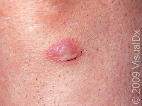 This image displays a pus-filled lesion with crust due to a impetigo, a superficial skin infection from either strep or staph bacteria.