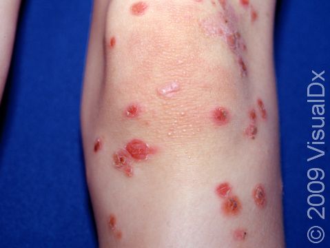 Impetigo can cause many scattered, red, and crusted skin lesions, as seen here.