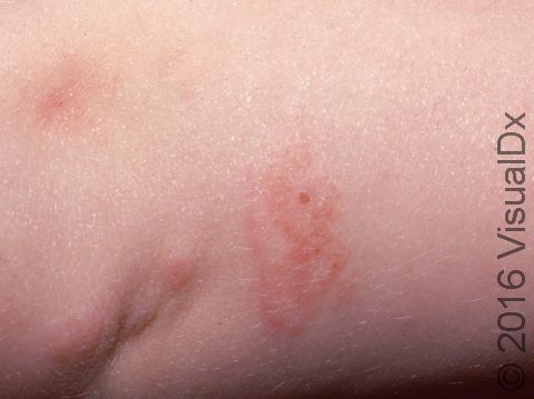 This is mild dermatitis of the forearm of an infant.