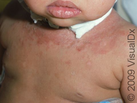 This hospitalized infant with contact irritant dermatitis had chaffing and irritation from the bandage around the neck.