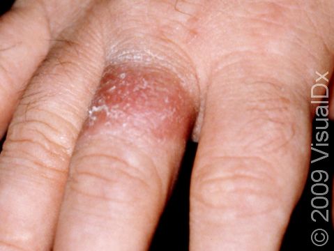 This image displays irritant dermatitis caused by a chemical trapped below the patient's ring.