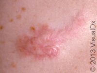 Keloid – Adult