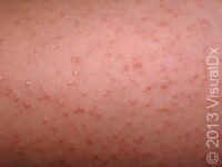 Keratosis Pilaris – Child