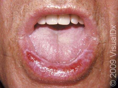 Lichen planus can cause erosions of the lips.