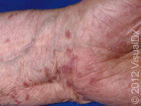 This image displays typical flat-topped, purple (violaceous) elevations of the skin at the wrist in lichen planus.