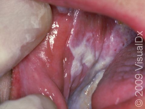 As displayed in this image, lichen planus is typically seen as white patches on the sides of the mouth lining.