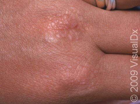 As displayed in this image, the top of the hand is a typical location for lichen simplex chronicus.