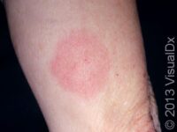 Lyme Disease – Adult