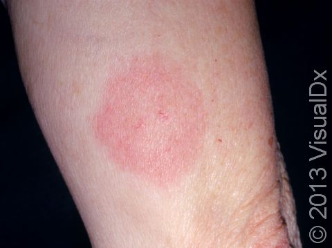 Lyme disease frequently presents as a red or pink circle that is short-lived, sometimes disappearing before the rash is noticed by the person affected.