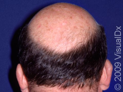 This image displays typical male pattern balding at the entire top of the scalp.