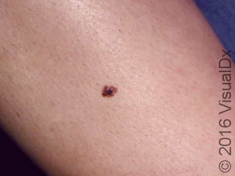 Small, but irregular, black and brown pigment is a sign of a melanoma, a serious skin cancer. Any new pigmented, itching, bleeding, or changing moles should be checked by your doctor.