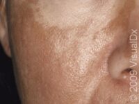 Melasma – Adult