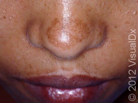 Sun-exposed areas of the face can be affected by melasma, seen on the nose and upper lip in this young woman.