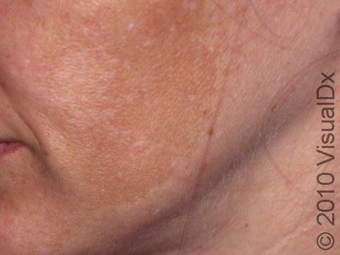 This image displays extensive melasma on the cheek area.