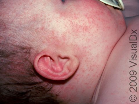 In miliaria rubra, blocked sweat glands cause small, red skin bumps.