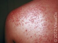 Heat Rash or Prickly Heat (Miliaria Rubra) – Adult