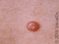 Molluscum Contagiosum (Pediatric) – Child