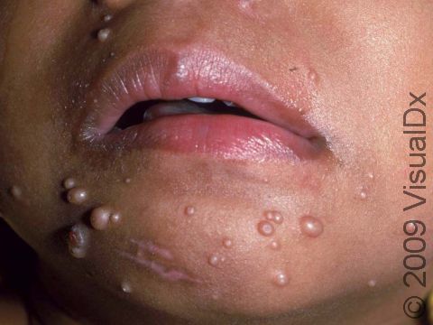 Molluscum lesions may be numerous and pearl-like in appearance; some spots on the child's chin show the characteristic indentation in the center.